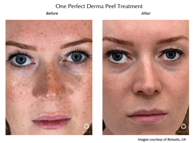 The Perfect Derma Peel