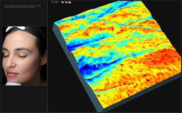Visia Complexion Analysis
