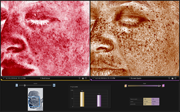 Visia Complexion Analysis