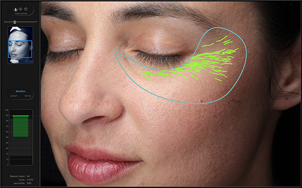 Visia Complexion Analysis