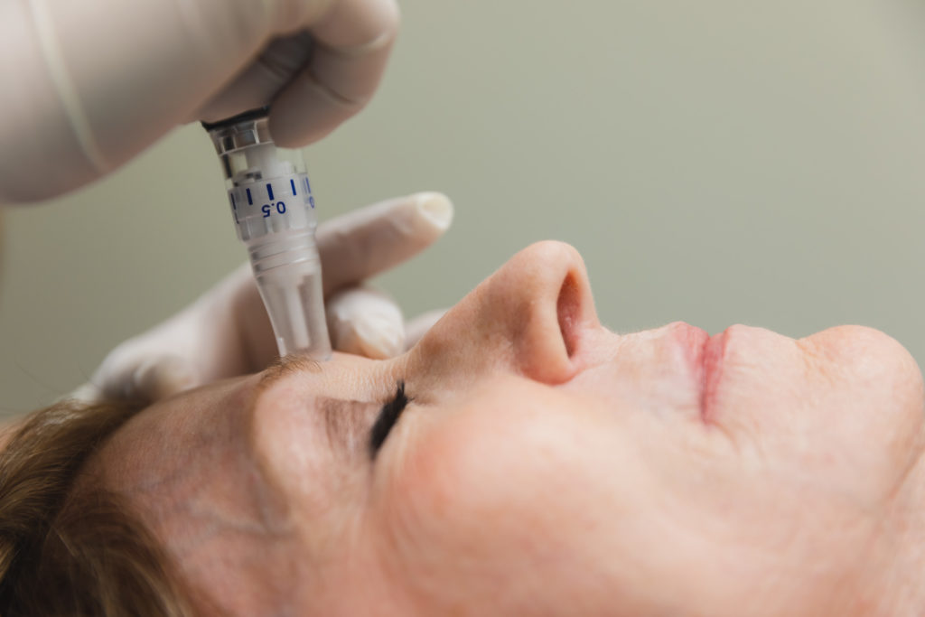 Close-up of woman with eyes closed receiving SkinPen microneedling from a doctor in the middle of her forehead.