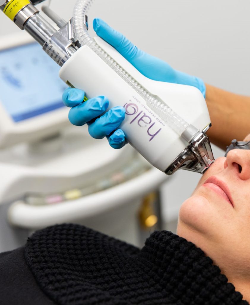 Close-up of physician using the cutting-edge Halo® laser treatment on a woman's face as she wears protective eye covering.