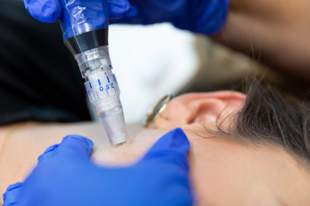 Close-up of SkinPen microneedling being applied by a doctor to skin on the side of a woman's cheek near the jawline.