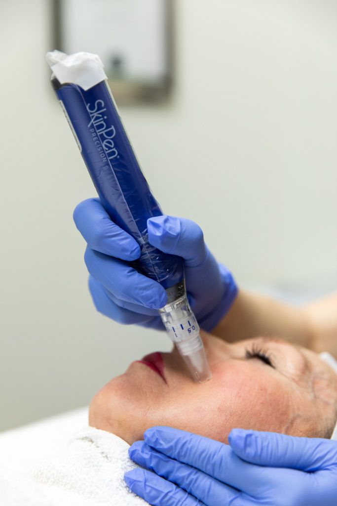 SkinPen microneedling being medically administered to a woman's face directly under her cheekbone.